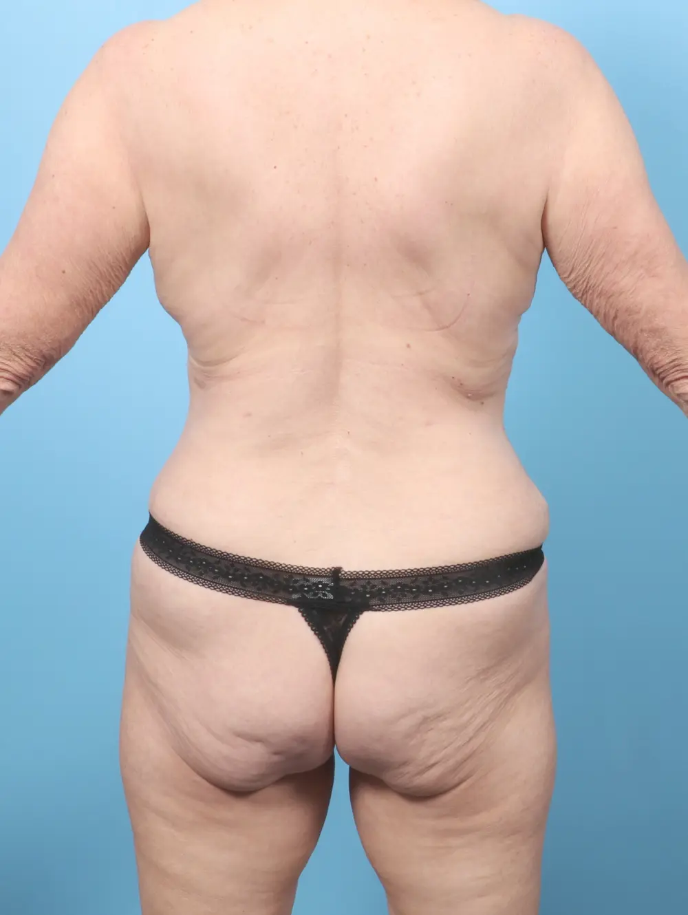 Breast Lift/Reduction w/o Implants Patient Photo - Case 59878 - after view-3