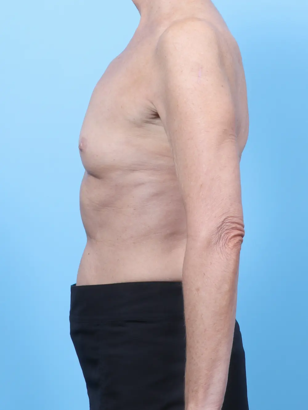 Breast Augmentation Patient Photo - Case 59921 - before view-2