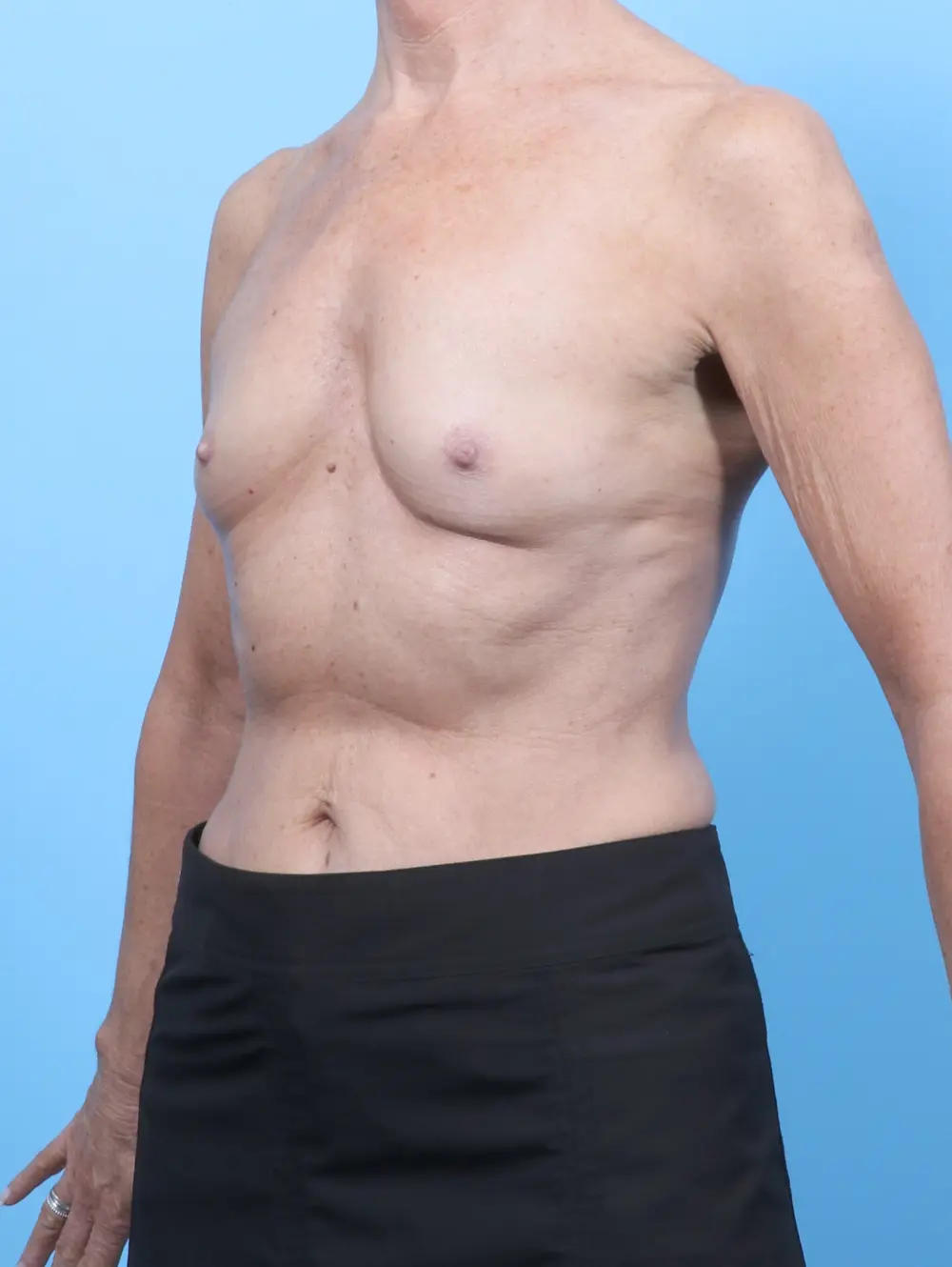 Breast Augmentation Patient Photo - Case 59921 - before view-1