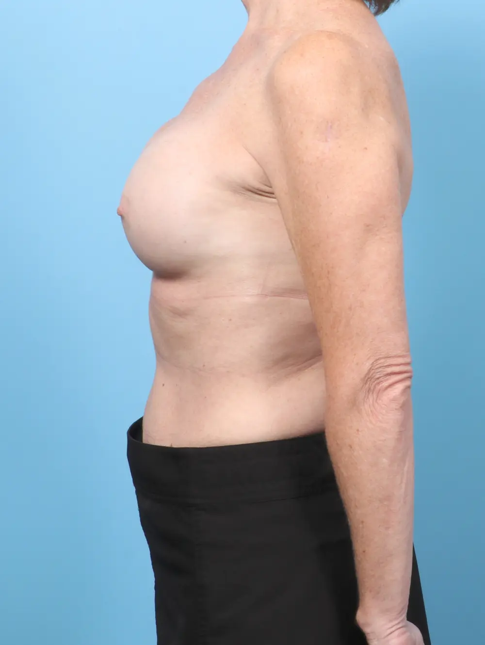 Breast Augmentation Patient Photo - Case 59921 - after view-2