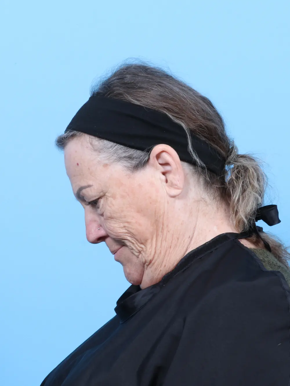 Eyelid Surgery Patient Photo - Case 59929 - before view-3