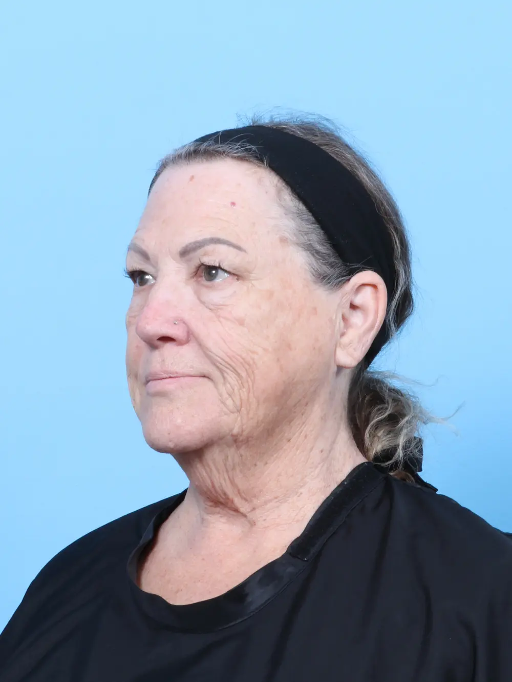 Eyelid Surgery Patient Photo - Case 59929 - before view-1