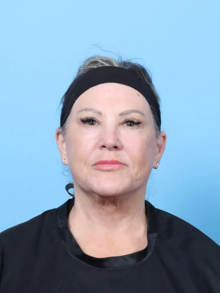 Eyelid Surgery - Case 59929 - After