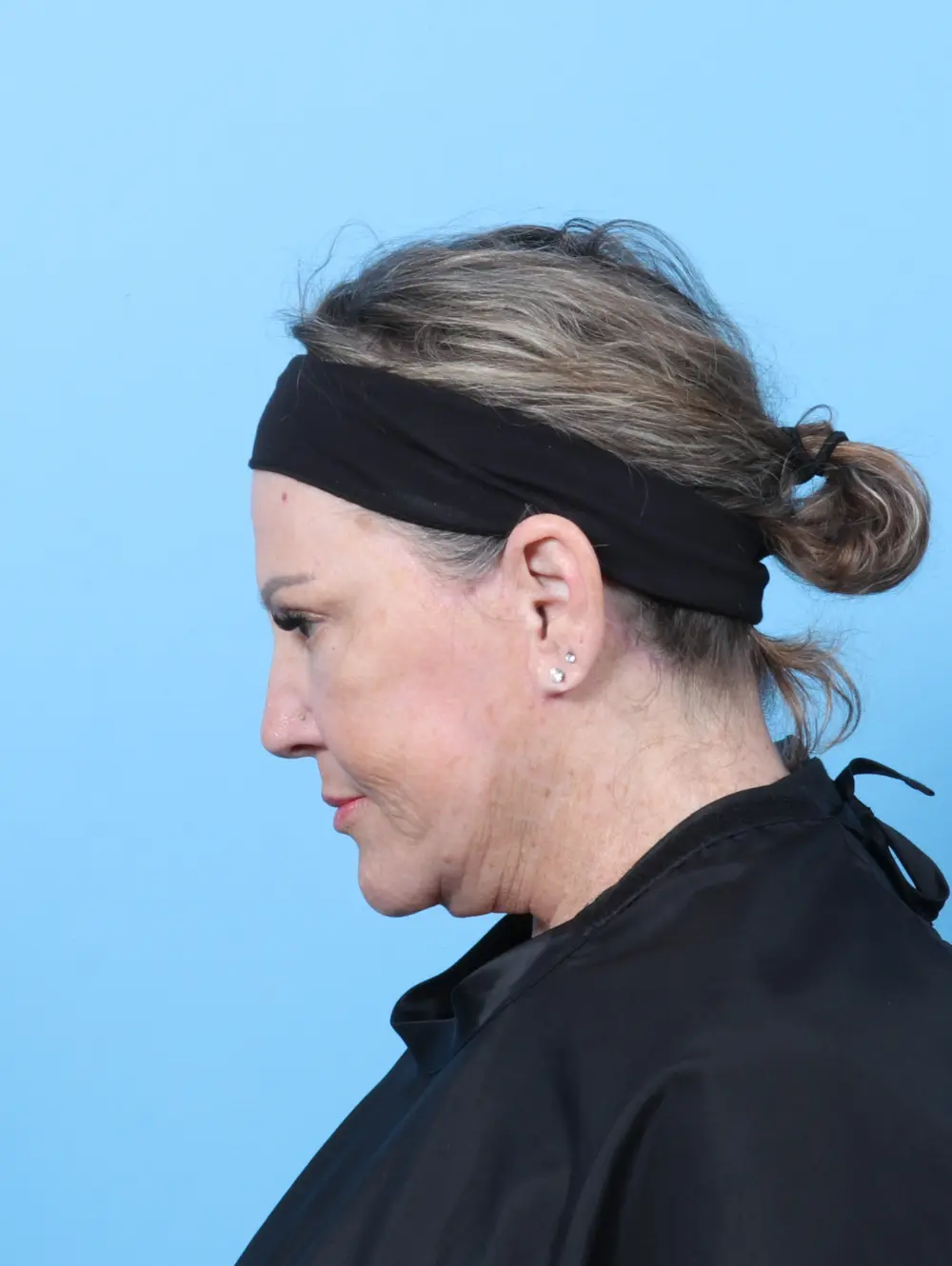 Eyelid Surgery Patient Photo - Case 59929 - after view-3