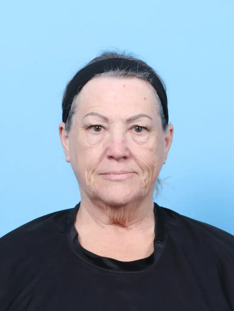 Eyelid Surgery - Case 59929 - Before