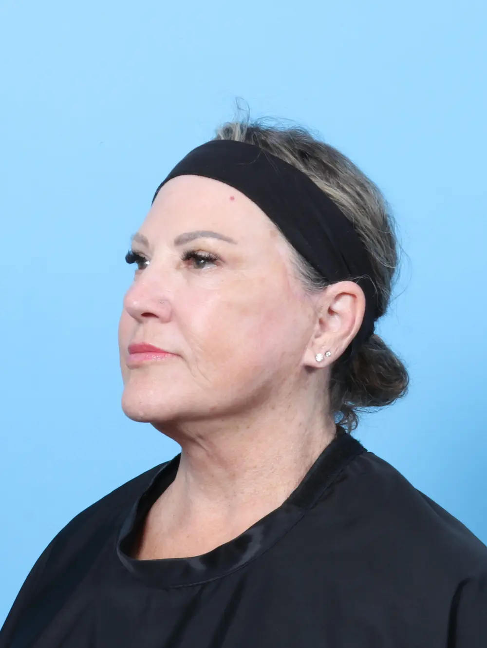 Eyelid Surgery Patient Photo - Case 59929 - after view-1