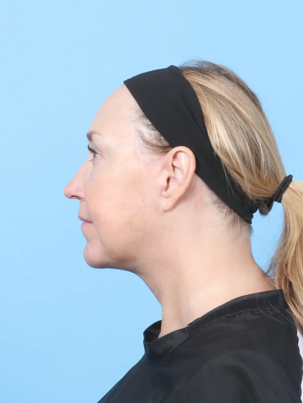 Buccal Fat Removal Patient Photo - Case 59964 - after view-2