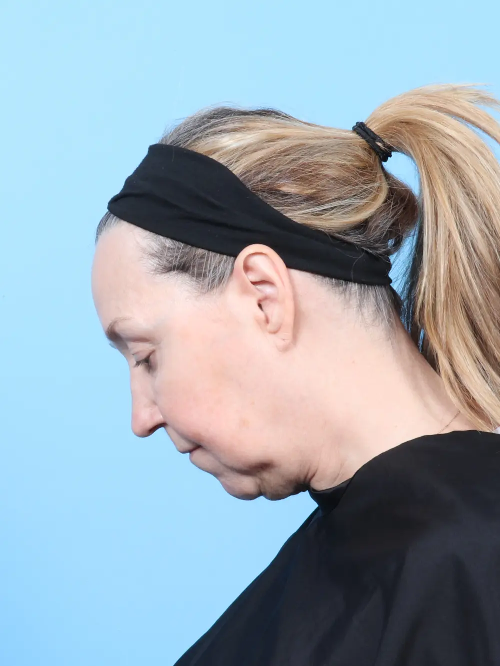 Buccal Fat Removal Patient Photo - Case 59964 - before view-3