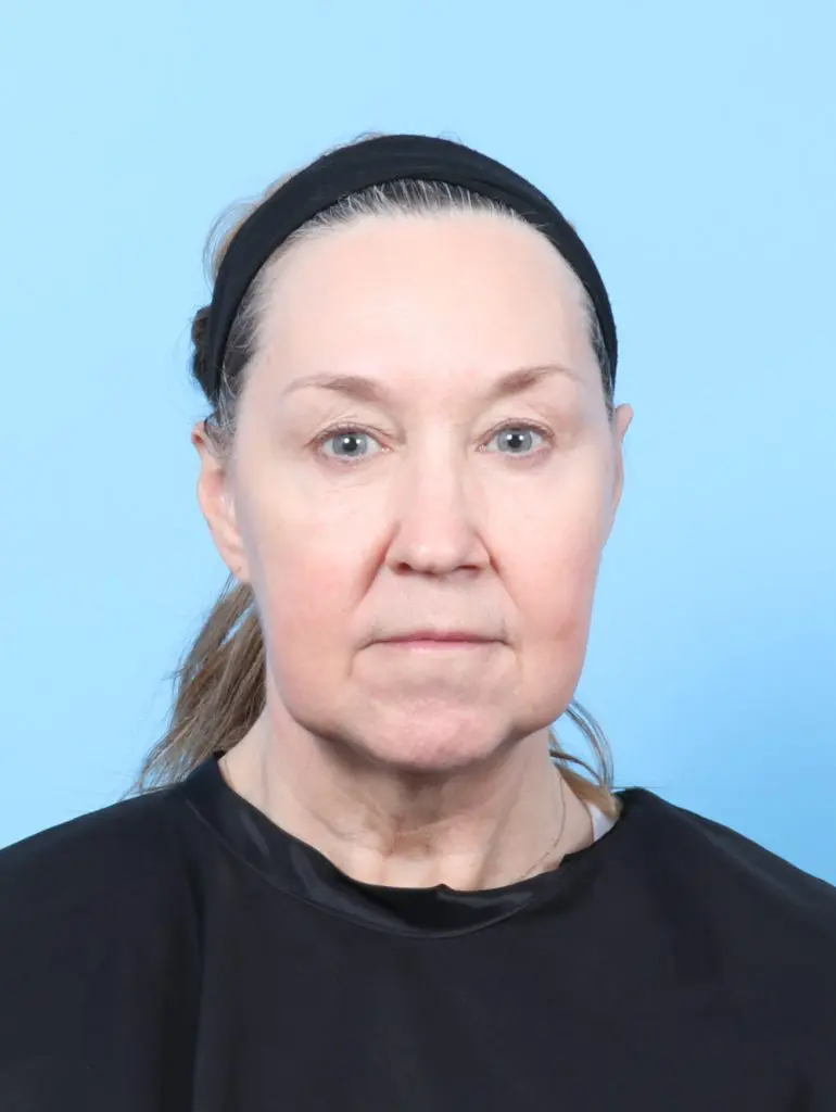 Buccal Fat Removal - Case 59964 - Before