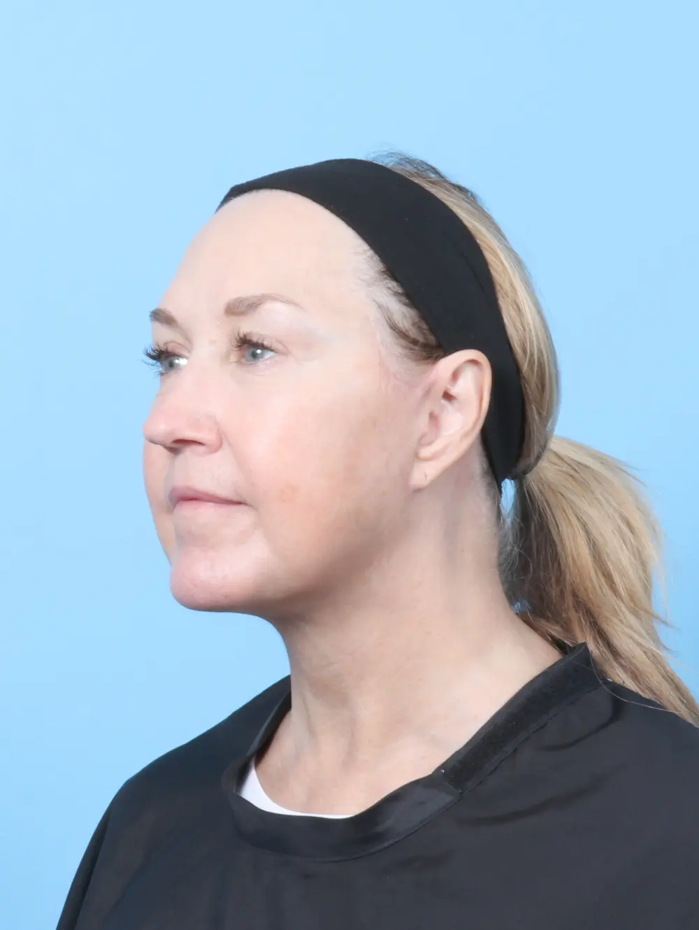 Buccal Fat Removal Patient Photo - Case 59964 - after view-1