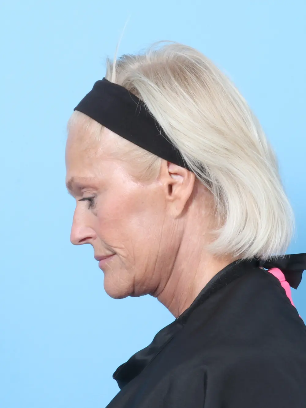 Eyelid Surgery Patient Photo - Case 59974 - after view-3