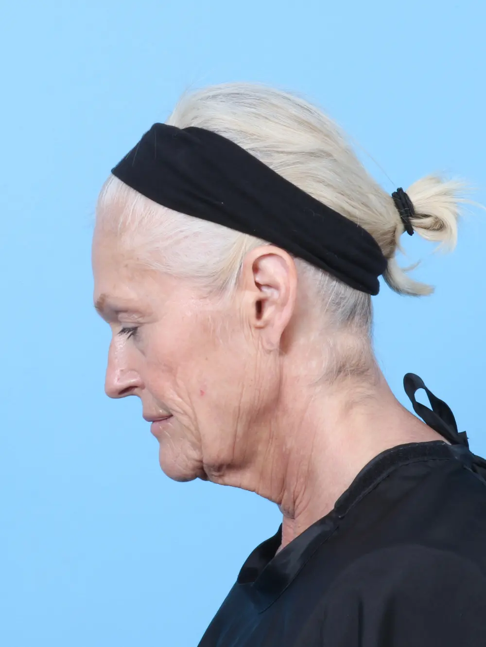 Eyelid Surgery Patient Photo - Case 59974 - before view-3