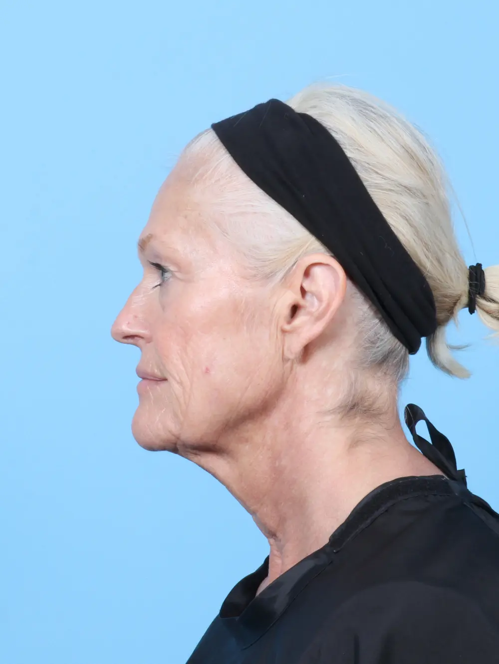 Eyelid Surgery Patient Photo - Case 59974 - before view-2