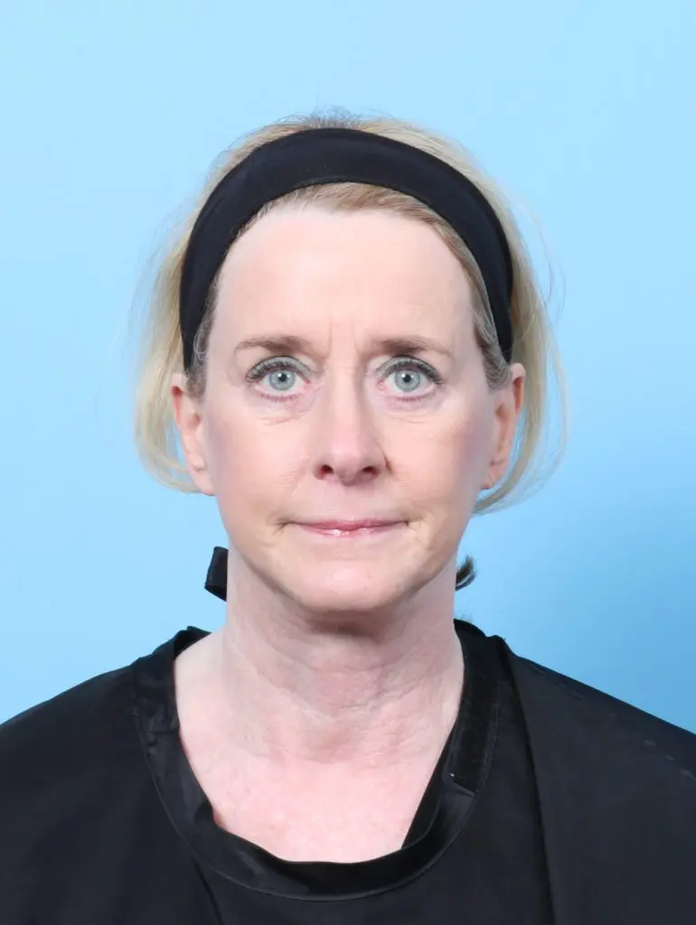 Bullhorn Lip Lift - Case 59984 - After