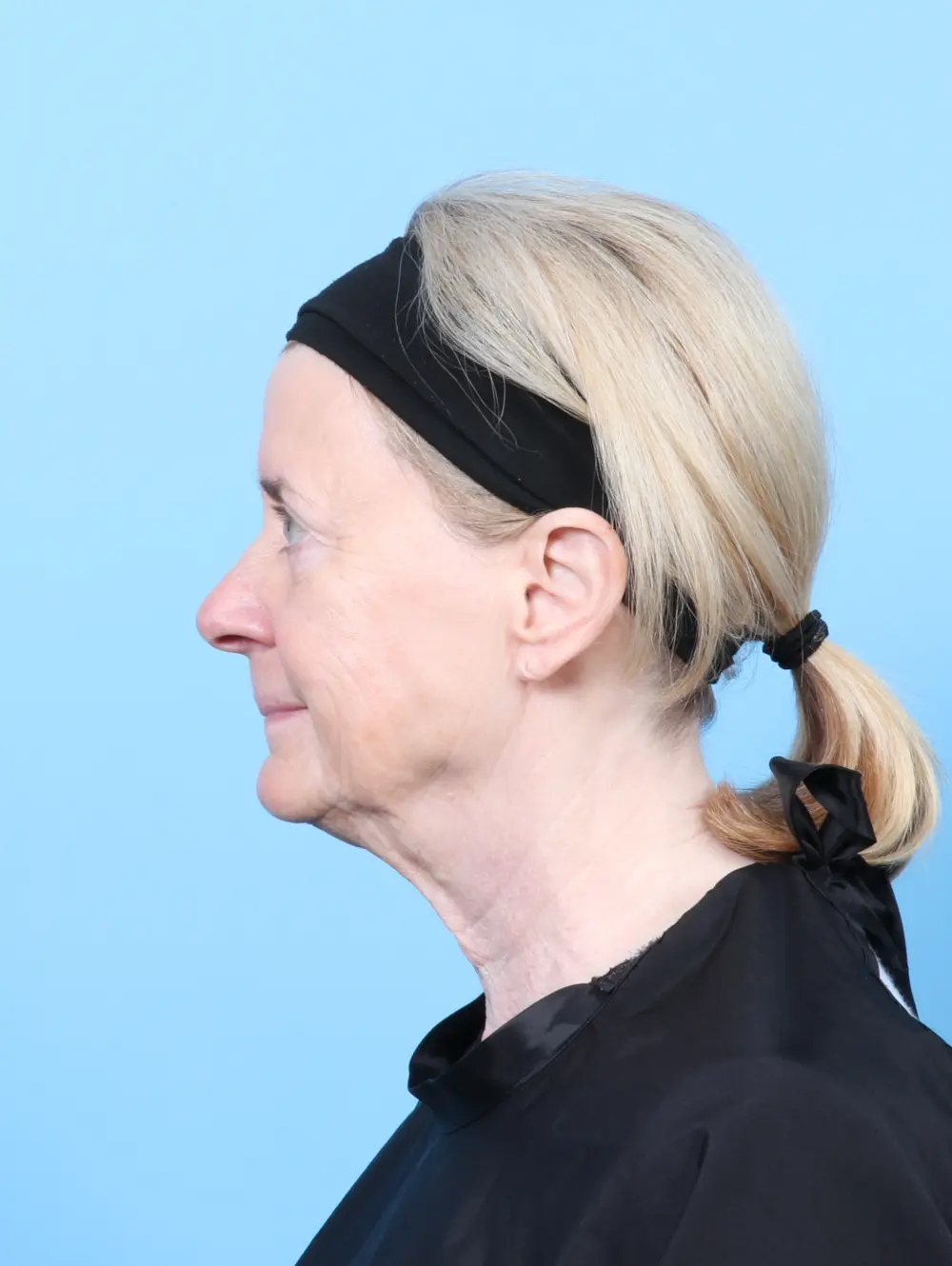 Bullhorn Lip Lift Patient Photo - Case 59984 - before view-2