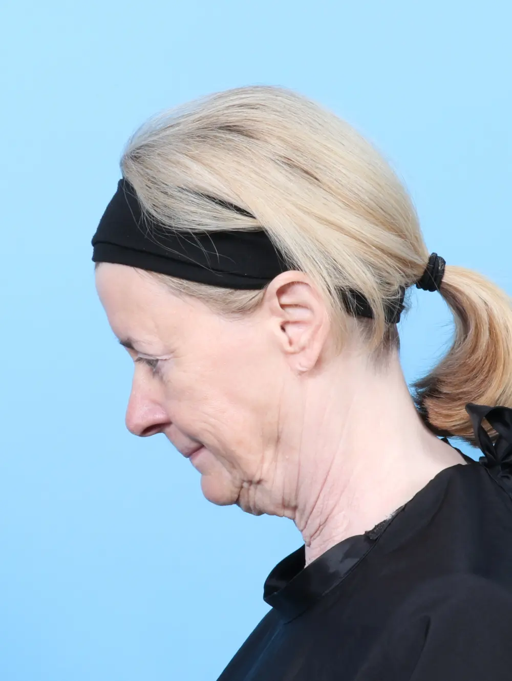 Bullhorn Lip Lift Patient Photo - Case 59984 - before view-3