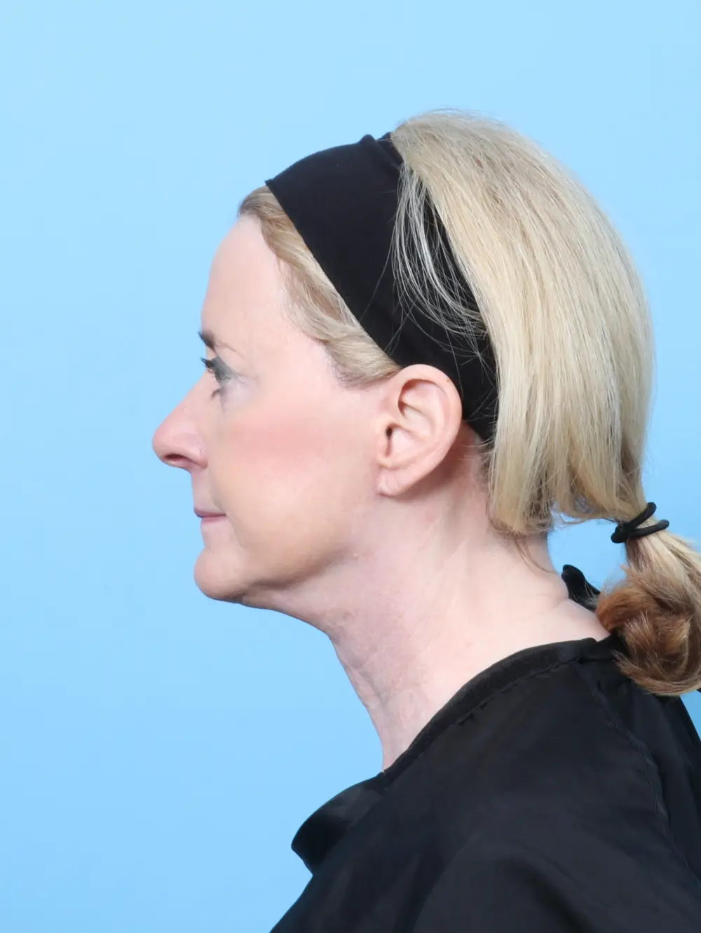 Bullhorn Lip Lift Patient Photo - Case 59984 - after view-2