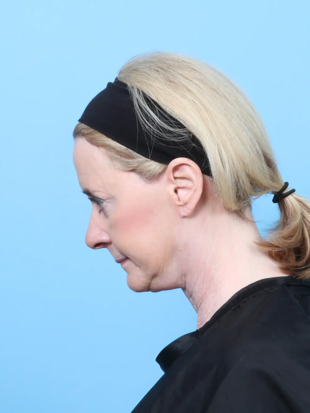 Bullhorn Lip Lift Patient Photo - Case 59984 - after view-3