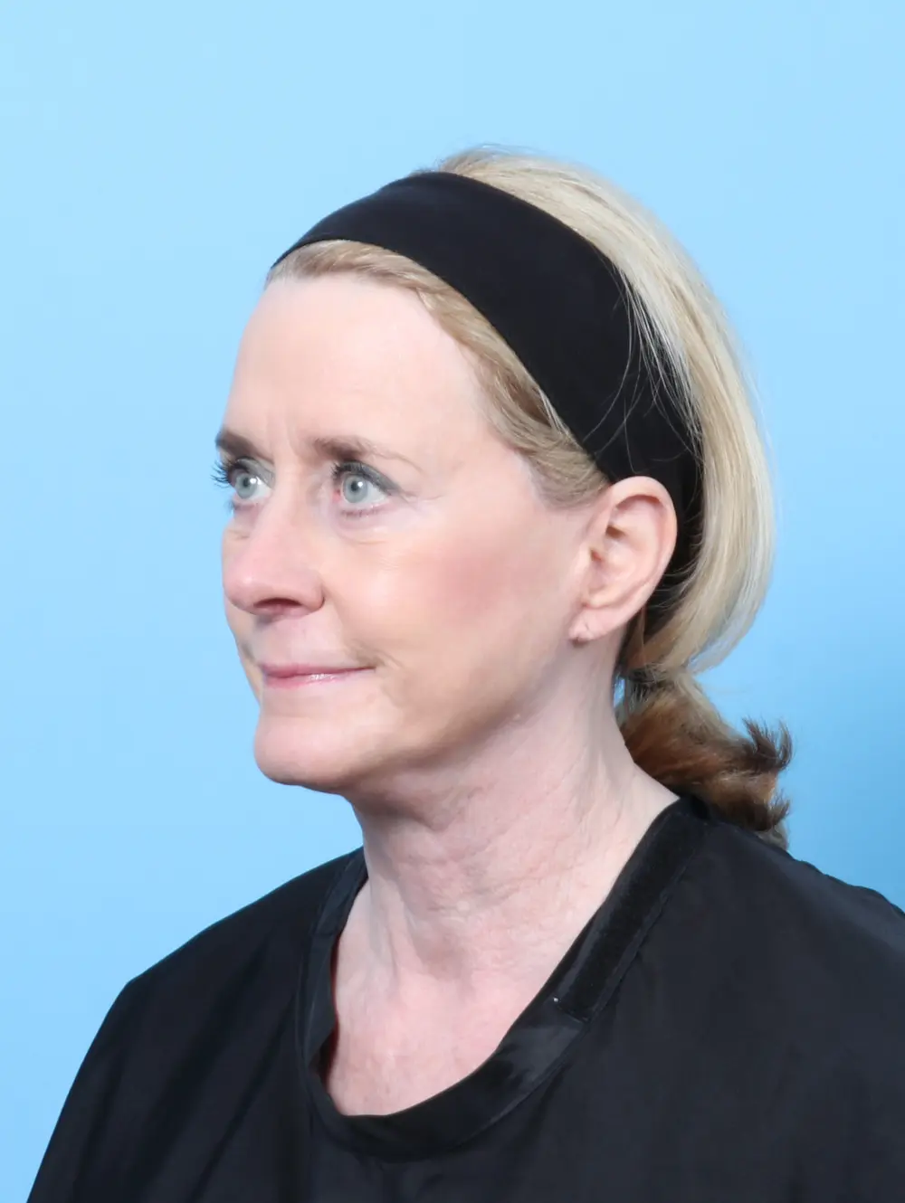 Bullhorn Lip Lift Patient Photo - Case 59984 - after view-1