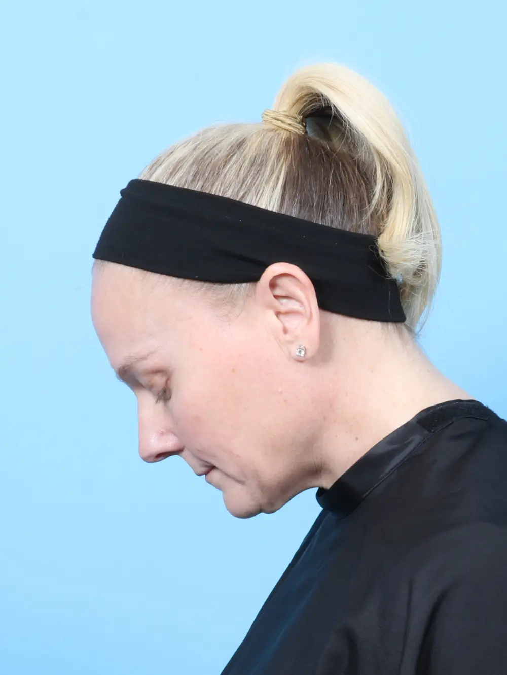 Eyelid Surgery Patient Photo - Case 60027 - before view-3