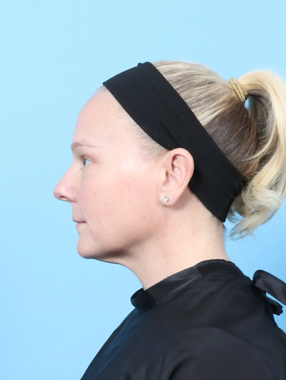 Eyelid Surgery Patient Photo - Case 60027 - before view-2