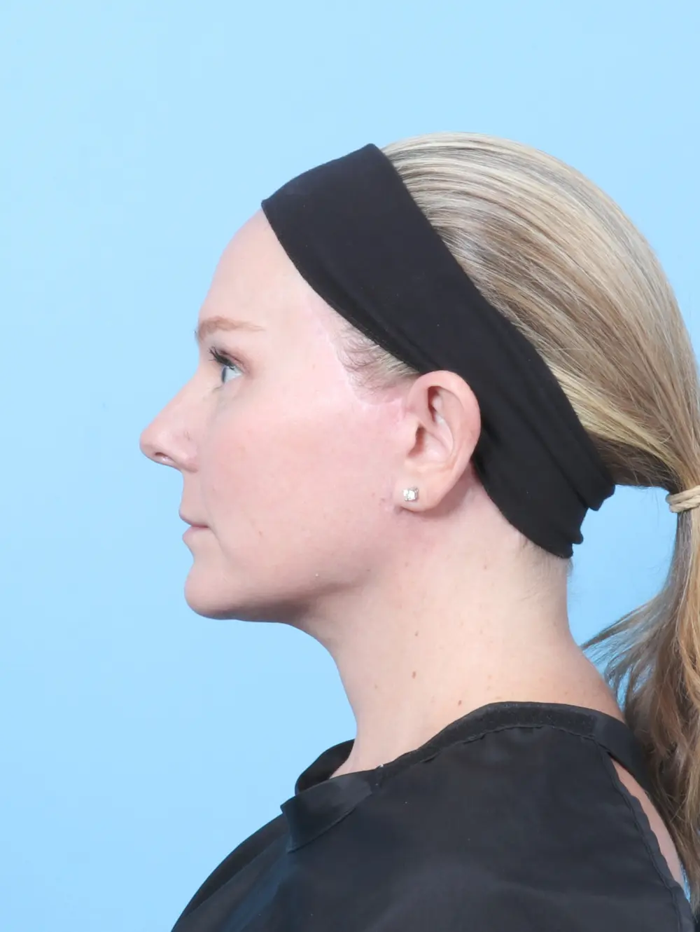 Eyelid Surgery Patient Photo - Case 60027 - after view-2