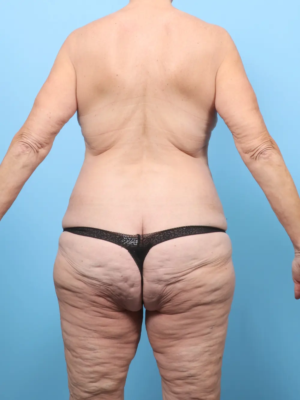 Breast Lift/Reduction with Implants Patient Photo - Case 60037 - before view-3