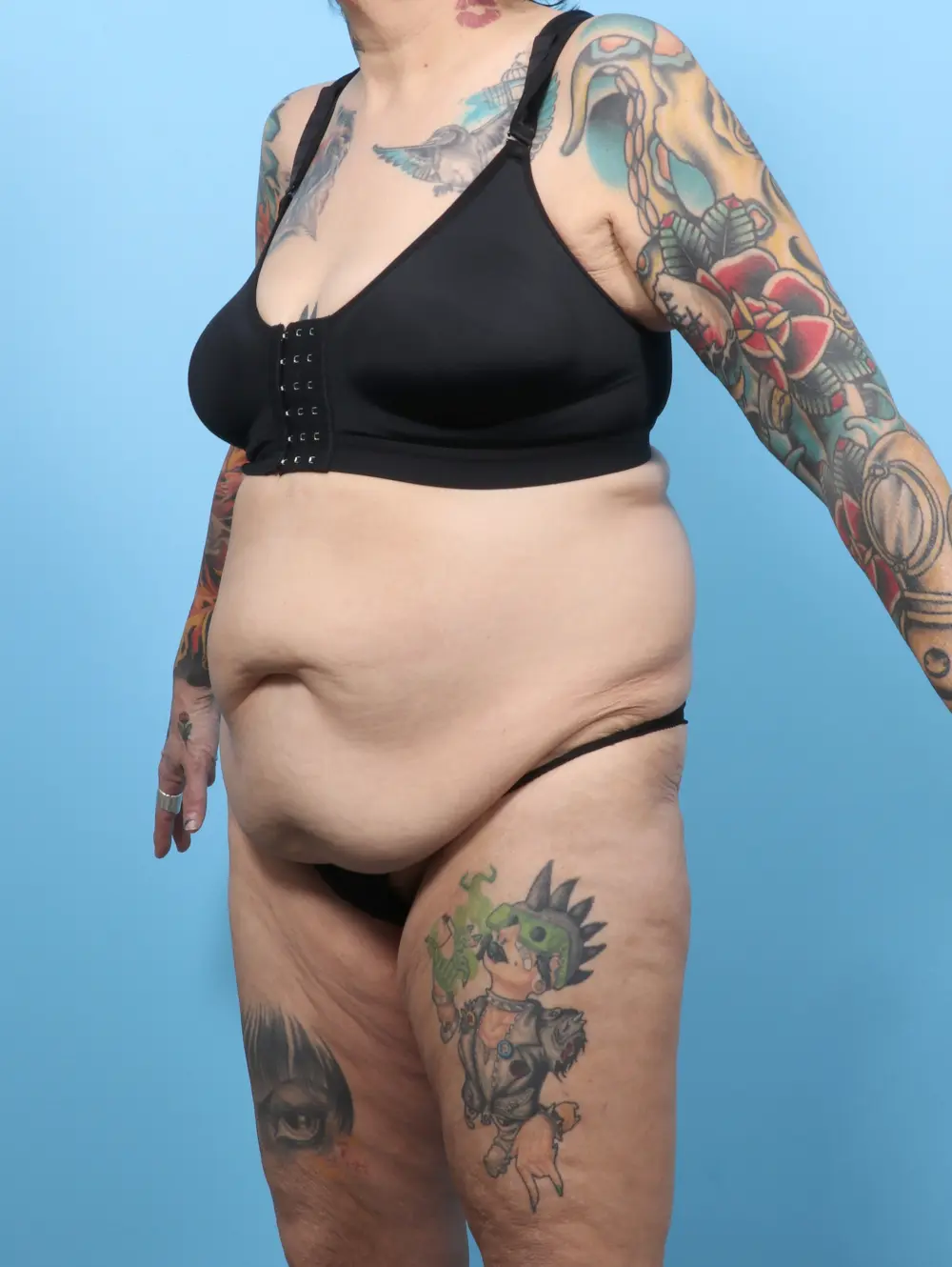 After Weight Loss Patient Photo - Case 60055 - before view-1