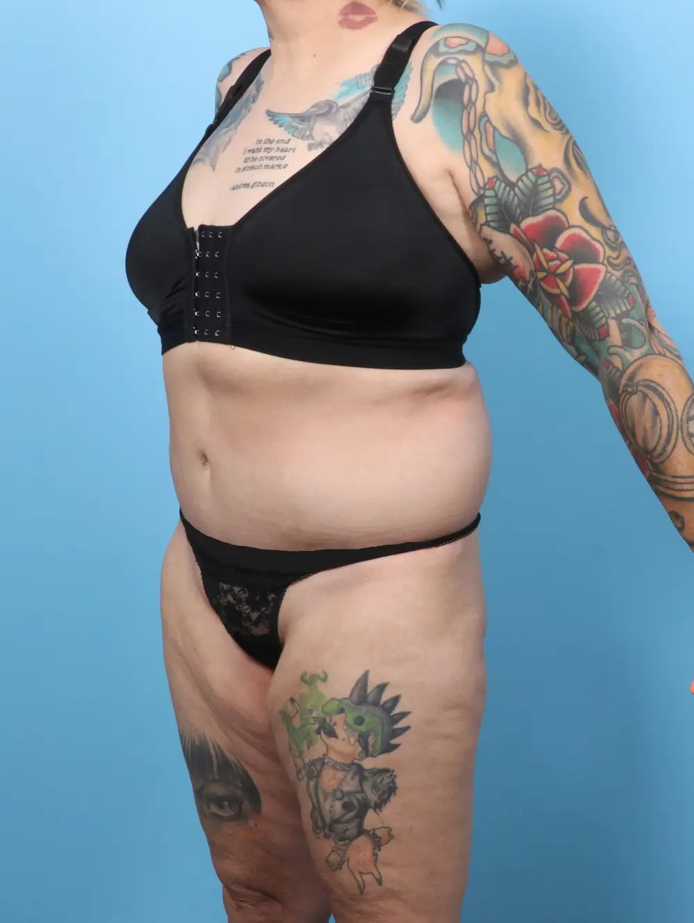 After Weight Loss Patient Photo - Case 60055 - after view-1