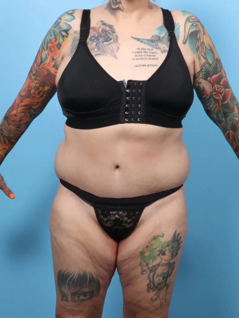 After Weight Loss - Case 60055 - After