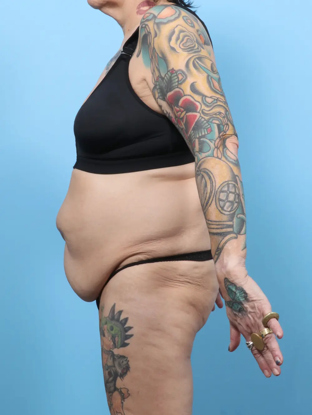 After Weight Loss Patient Photo - Case 60055 - before view-2