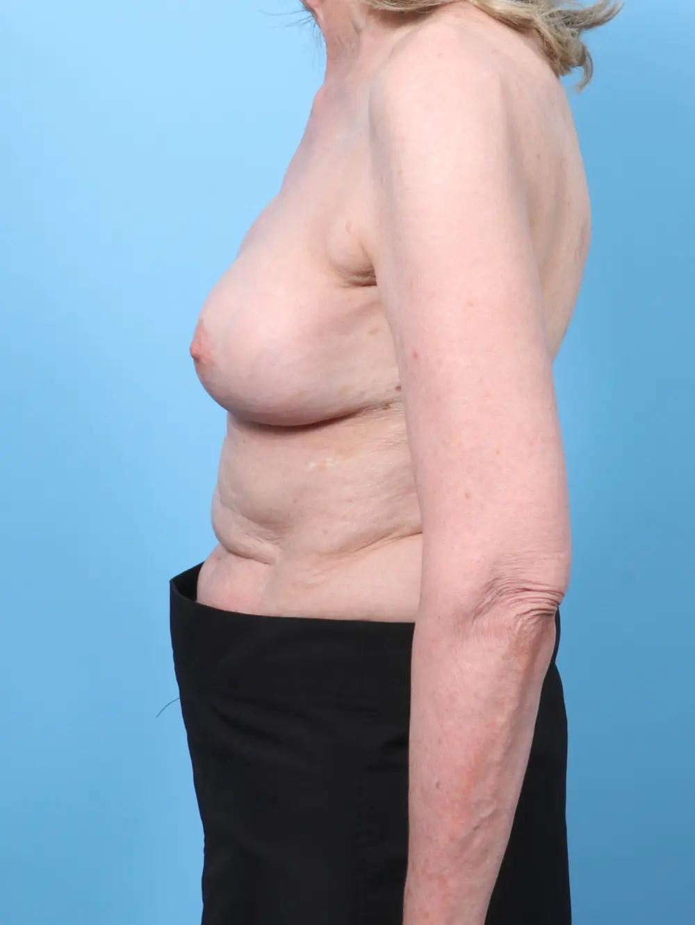 Breast Implant Revision Patient Photo - Case 60074 - after view-2
