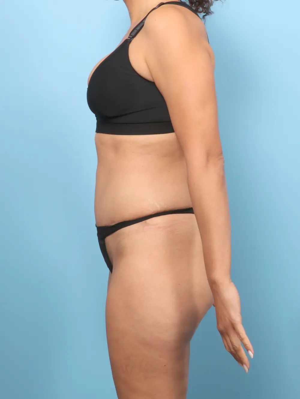 Tummy Tuck Patient Photo - Case 60082 - after view-2
