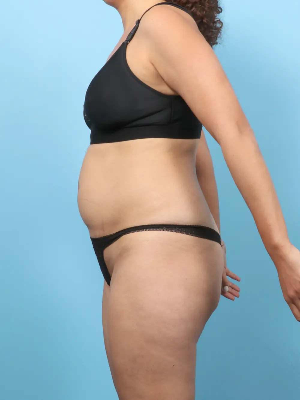 Tummy Tuck Patient Photo - Case 60082 - before view-2