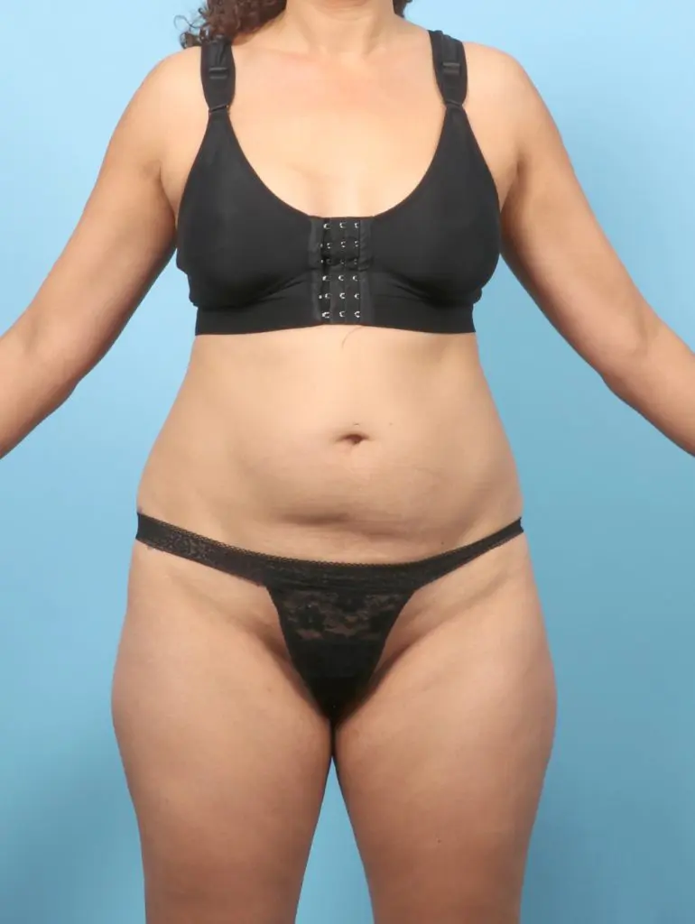 Tummy Tuck - Case 60082 - Before