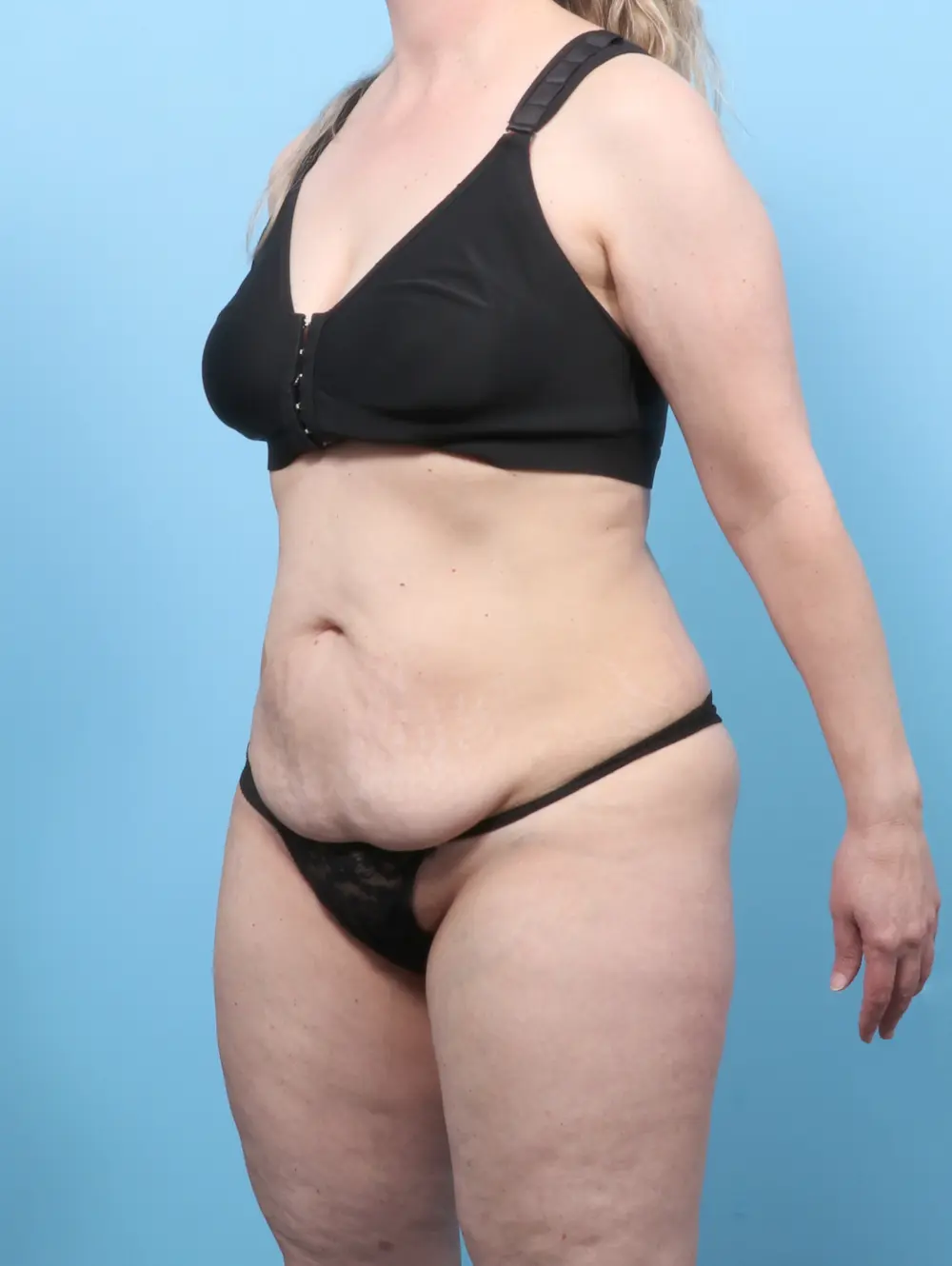 Tummy Tuck Patient Photo - Case 60102 - before view-1