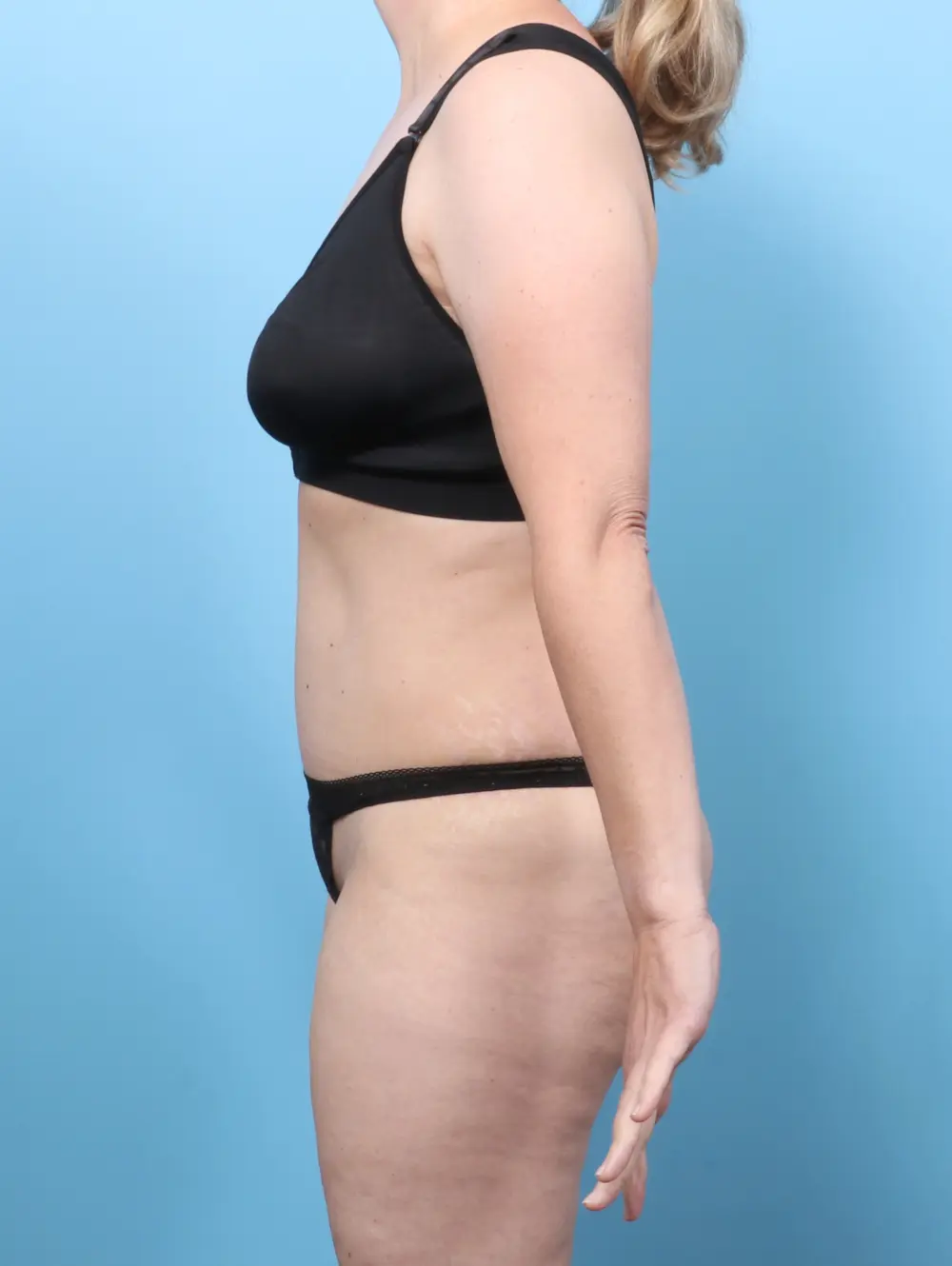 Tummy Tuck Patient Photo - Case 60102 - after view-2