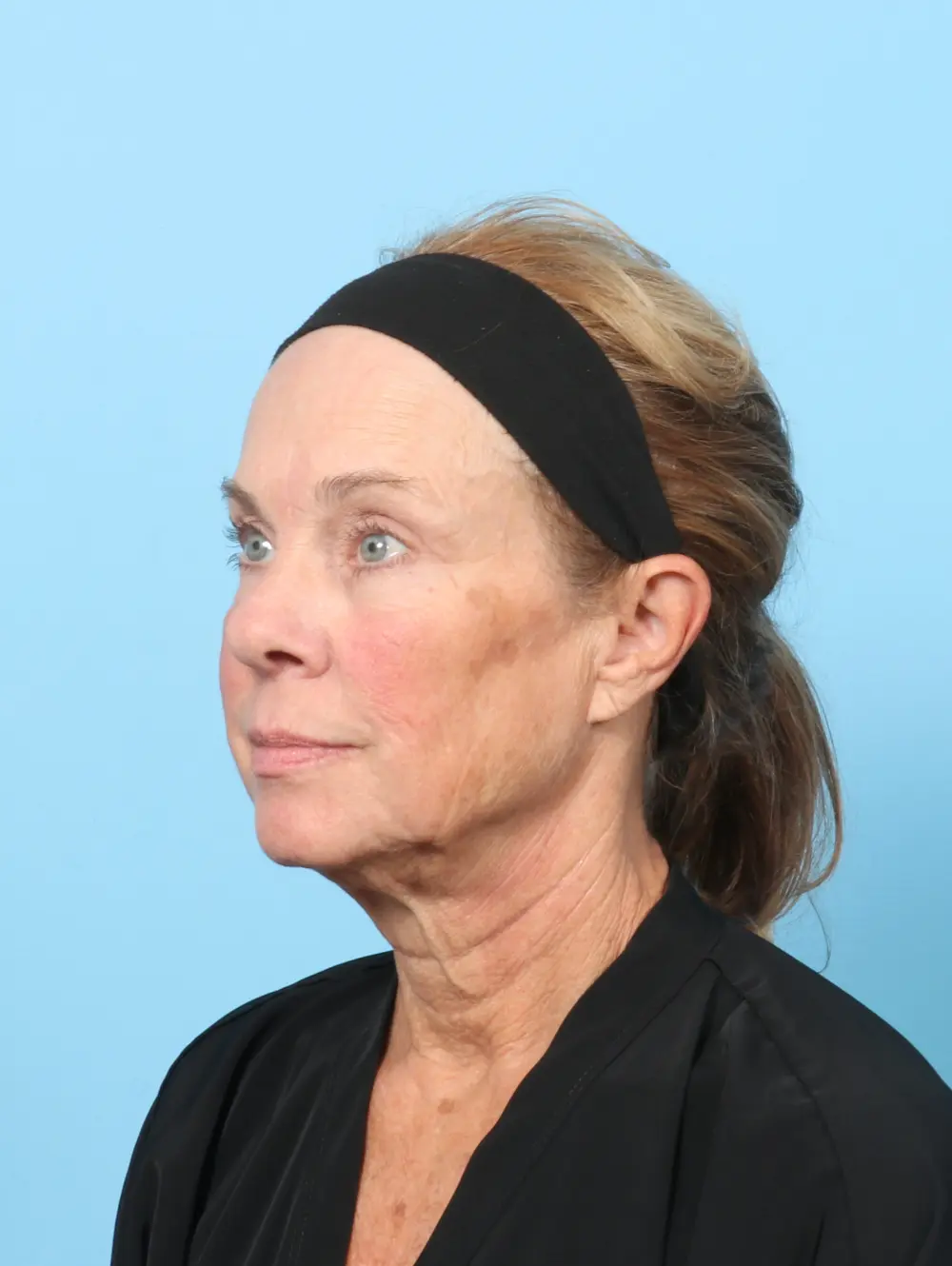 Eyelid Surgery Patient Photo - Case 60162 - after view-1