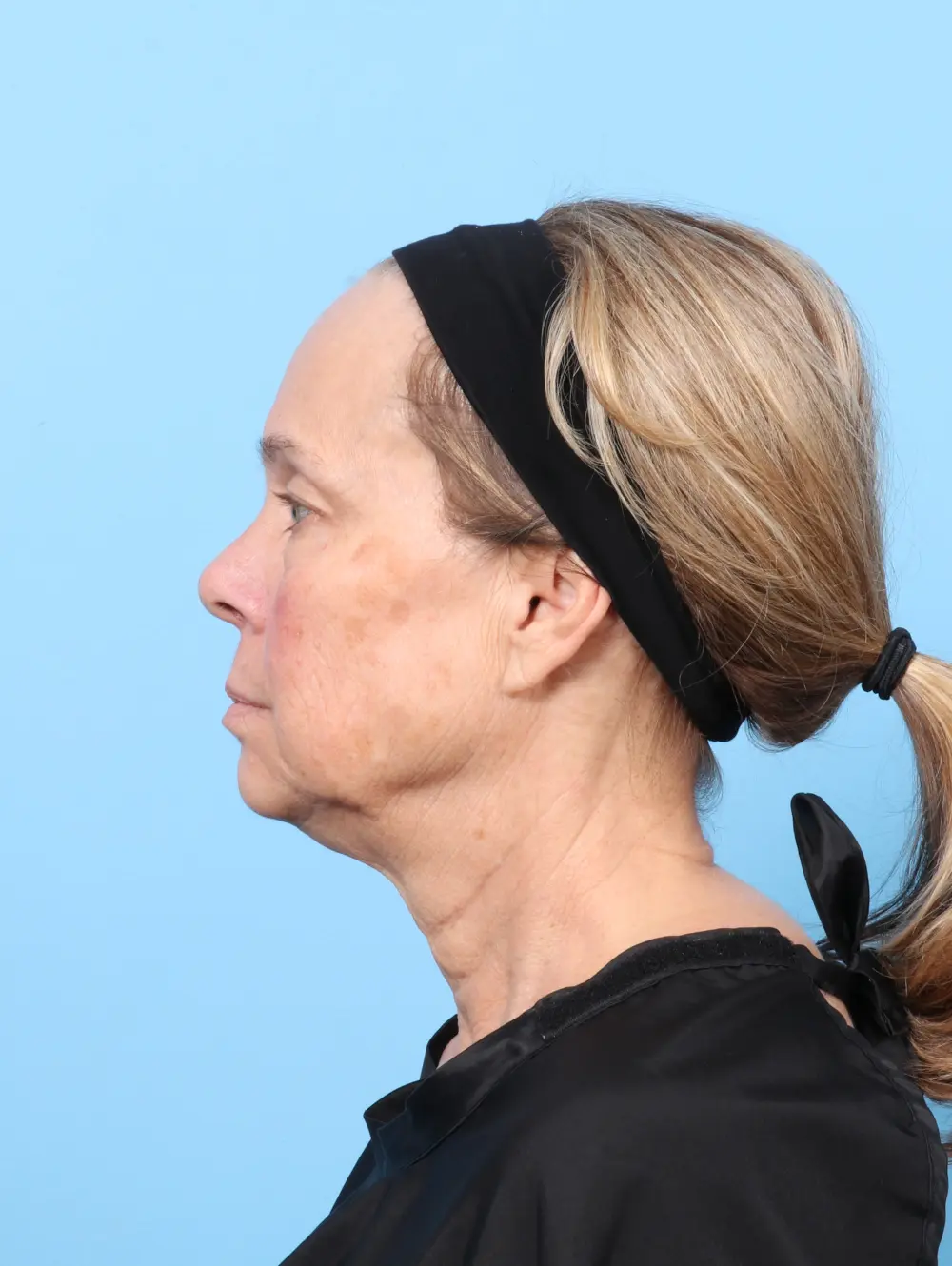 Eyelid Surgery Patient Photo - Case 60162 - before view-2