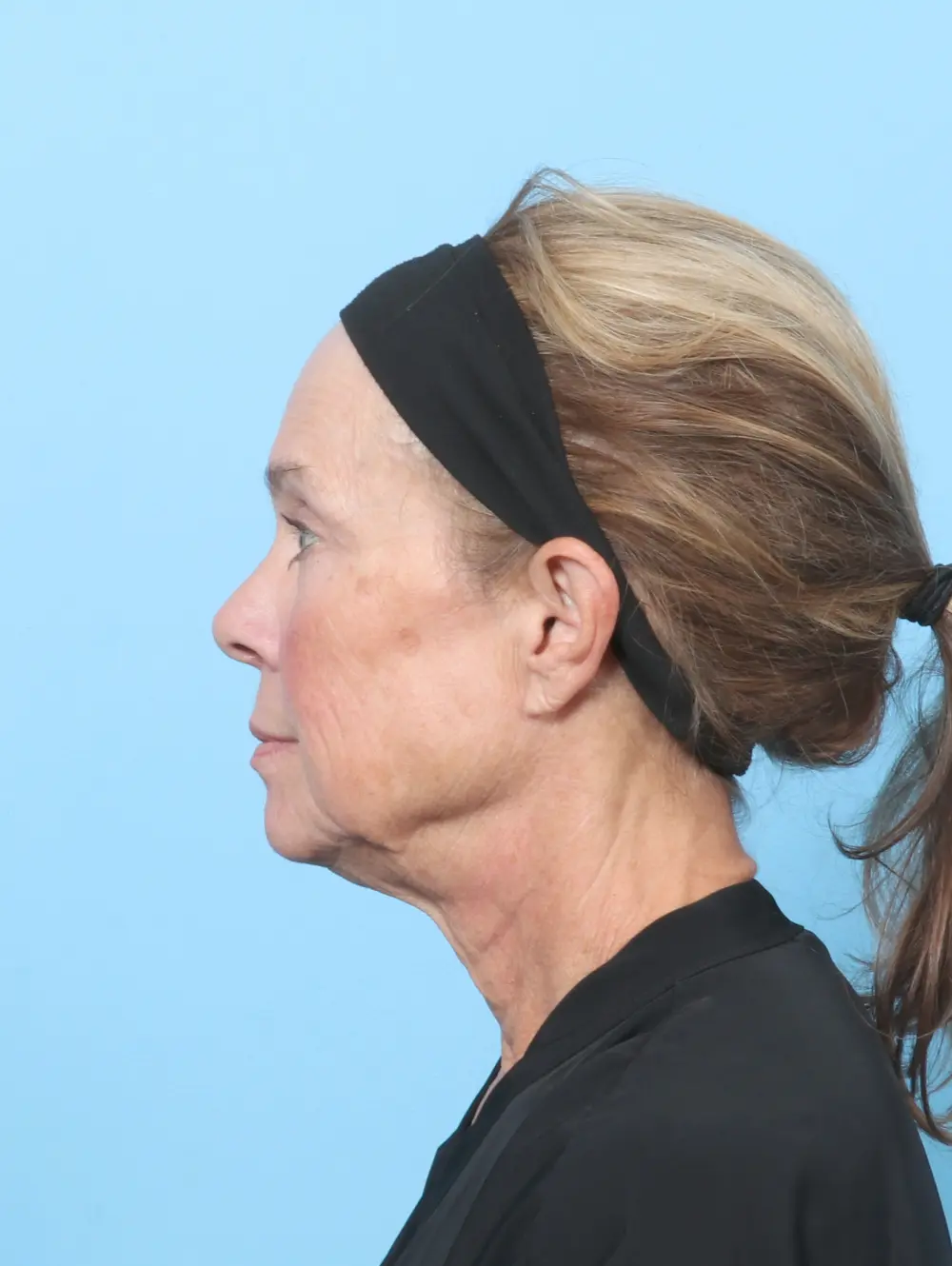 Eyelid Surgery Patient Photo - Case 60162 - after view-2