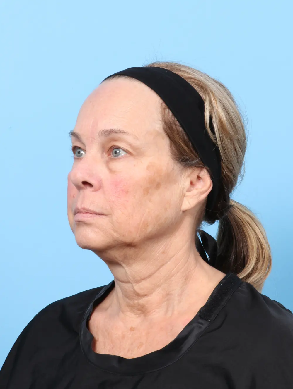 Eyelid Surgery Patient Photo - Case 60162 - before view-1