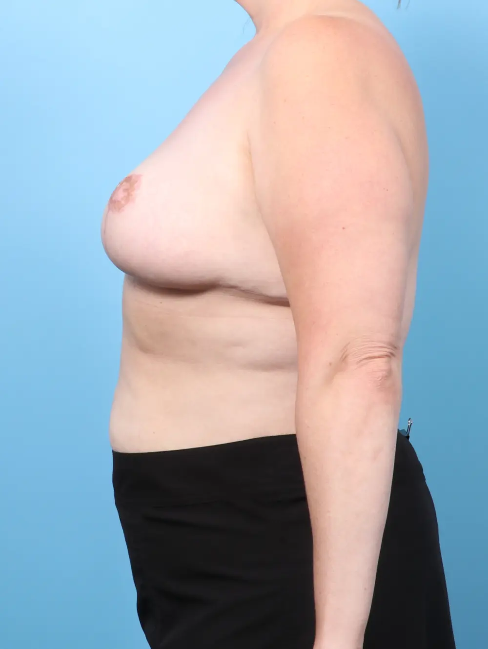 Breast Lift/Reduction w/o Implants Patient Photo - Case 60186 - after view-2