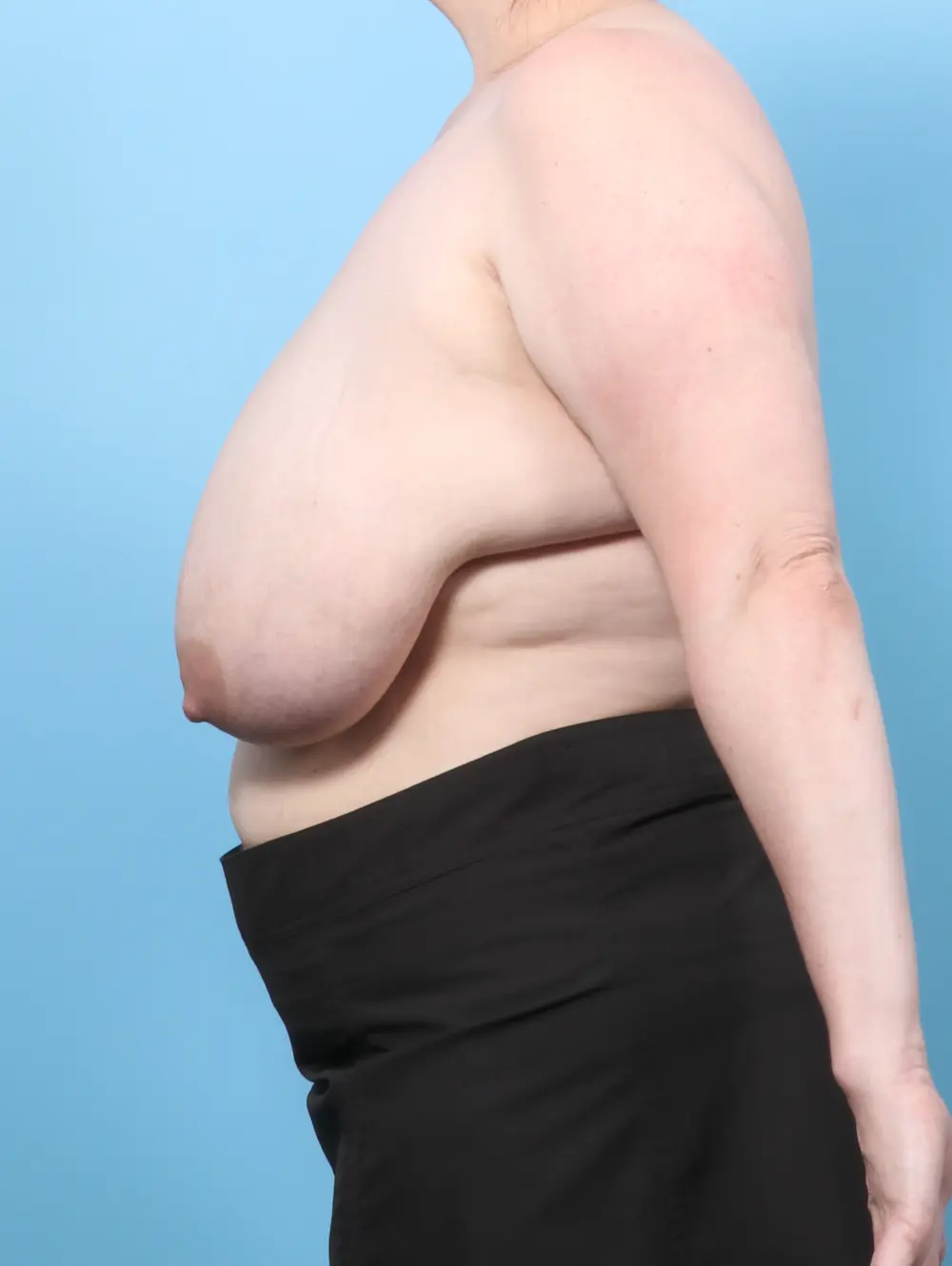 Breast Lift/Reduction w/o Implants Patient Photo - Case 60186 - before view-2