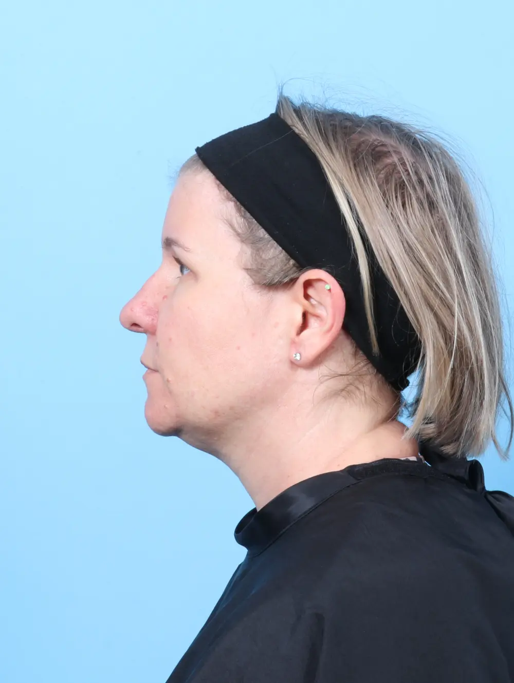 Brow Lift Patient Photo - Case 60202 - after view-2