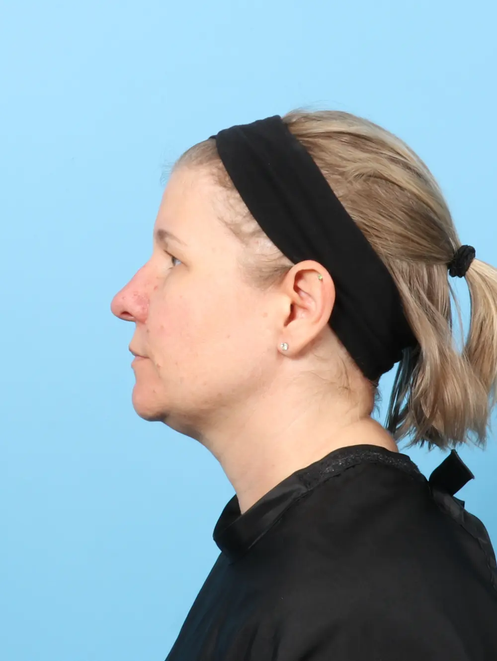 Brow Lift Patient Photo - Case 60202 - before view-2