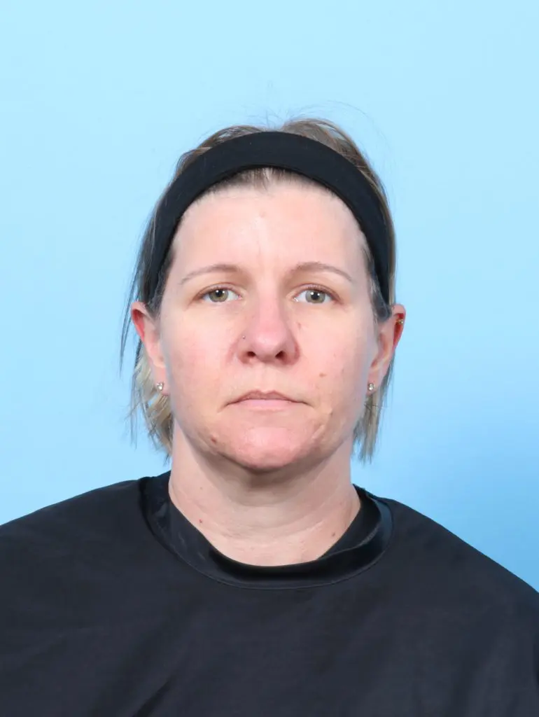 Brow Lift - Case 60202 - After