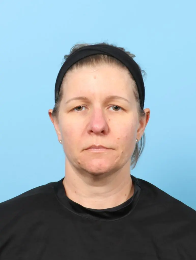 Brow Lift - Case 60202 - Before