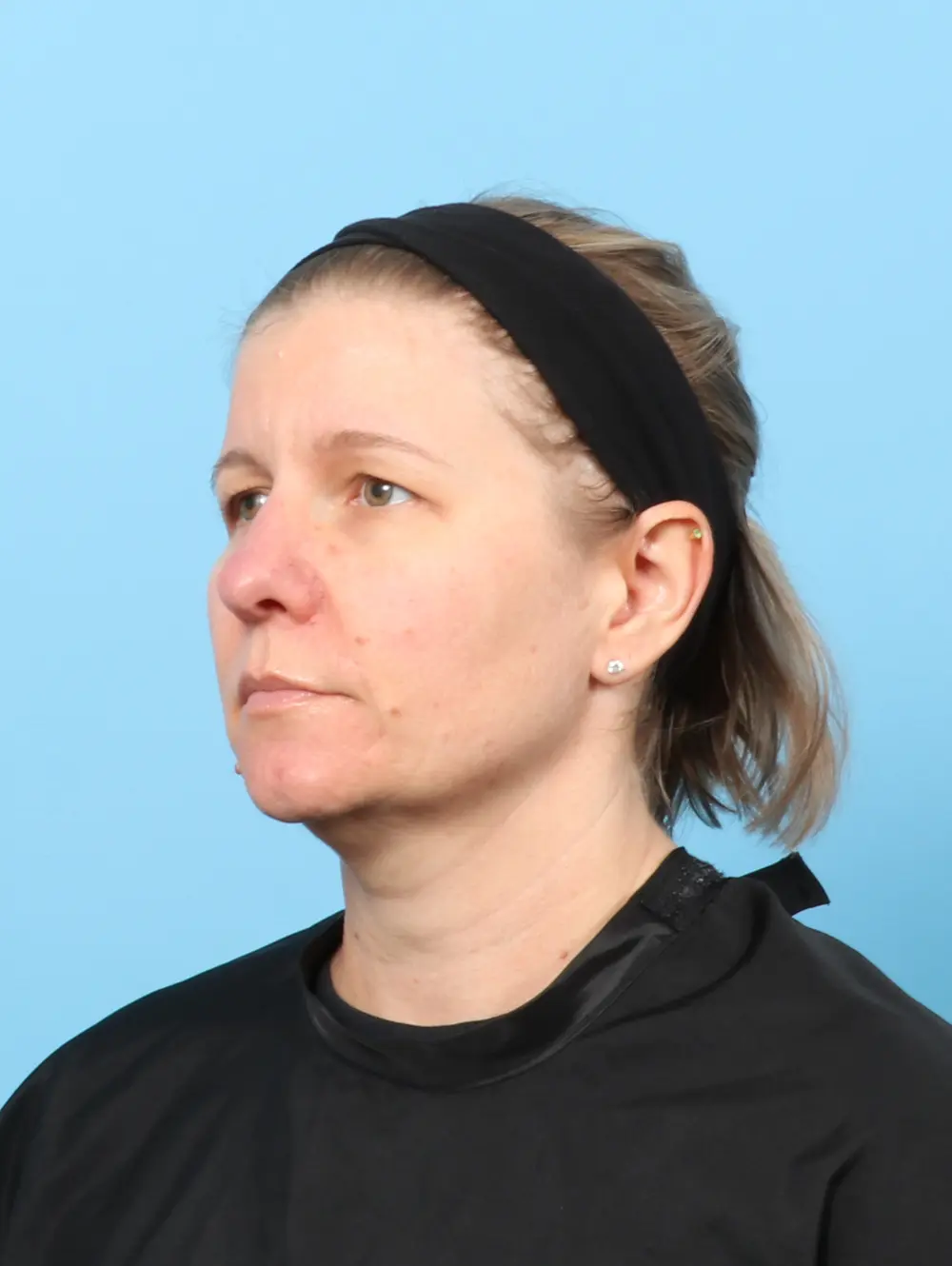 Brow Lift Patient Photo - Case 60202 - before view-1