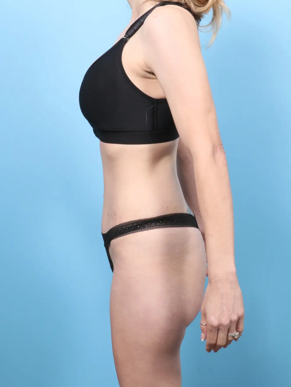 Tummy Tuck Patient Photo - Case 60210 - after view-2