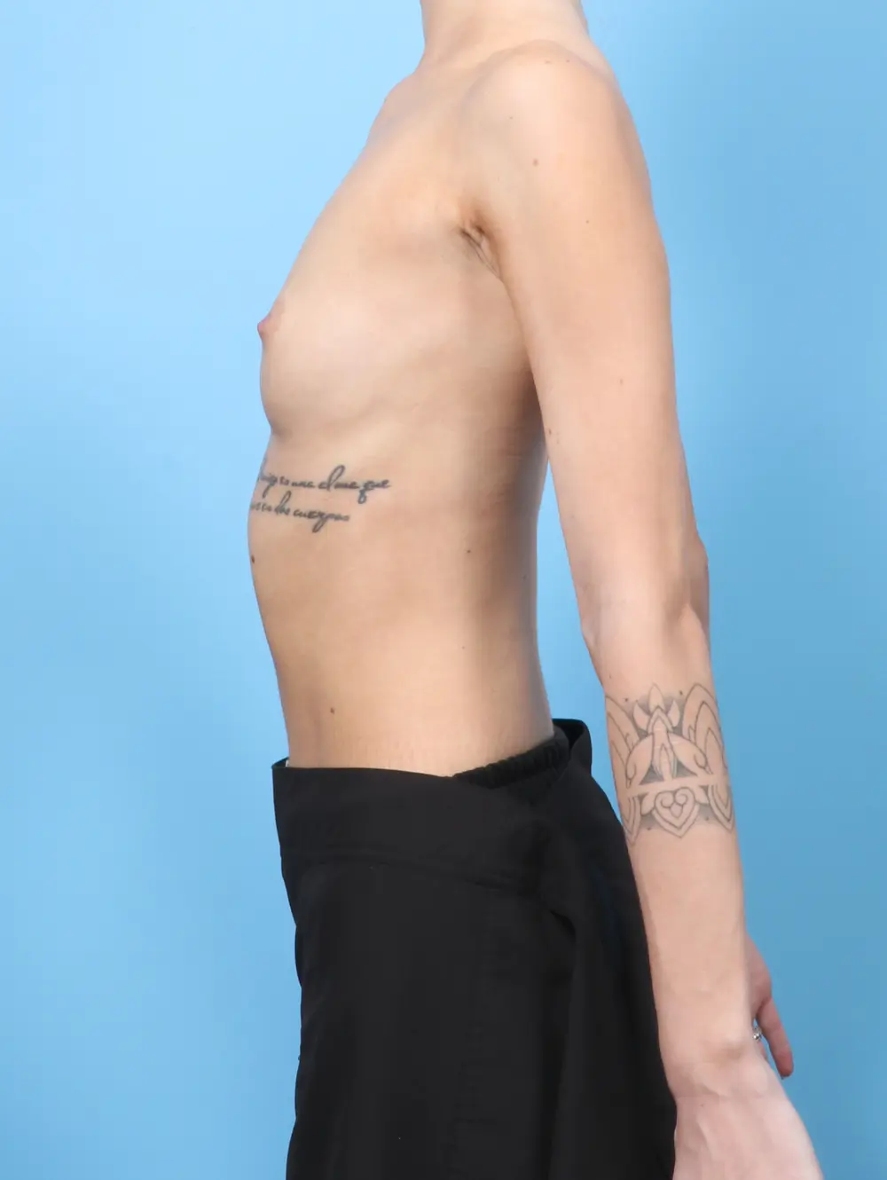 Breast Augmentation Patient Photo - Case 60218 - before view-2